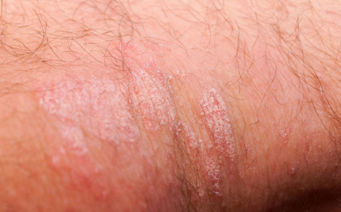 Behandling av psoriasis