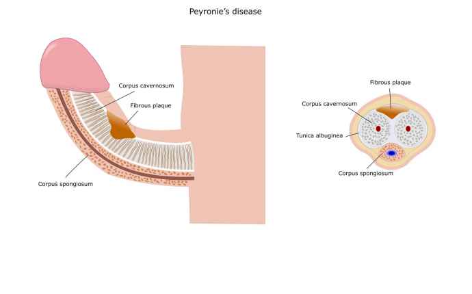 Snabbkoll: Här är symptomen på krokig penis (Peyronies sjukdom)