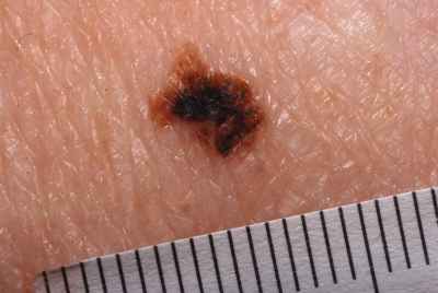 dysplasisk nevus2