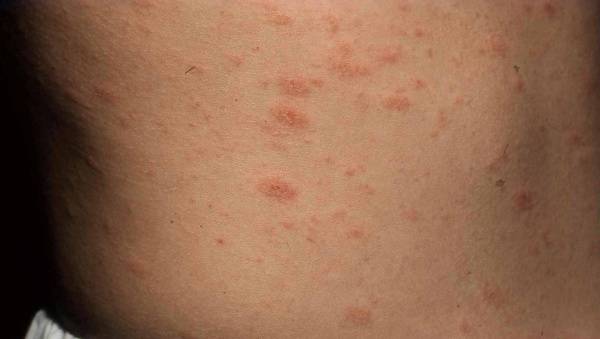 guttat psoriasis