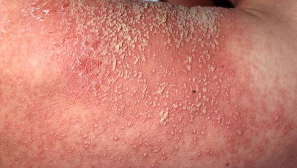 pustulos psoriasis2