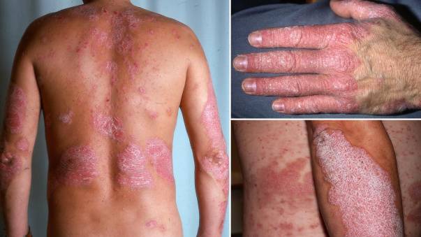 plack psoriasis